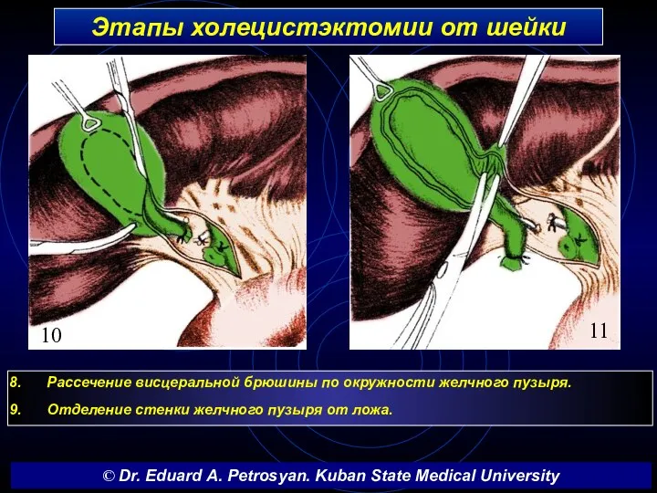 Этапы холецистэктомии от шейки Рассечение висцеральной брюшины по окружности желчного