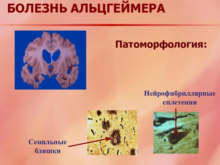 БОЛЕЗНЬ АЛЬЦГЕЙМЕРА Сенильные бляшки Нейрофибриллярные сплетения Патоморфология: