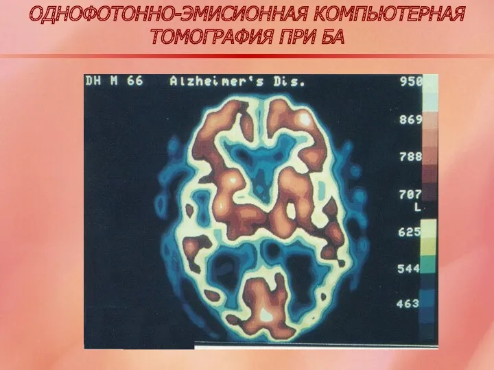 ОДНОФОТОННО-ЭМИСИОННАЯ КОМПЬЮТЕРНАЯ ТОМОГРАФИЯ ПРИ БА