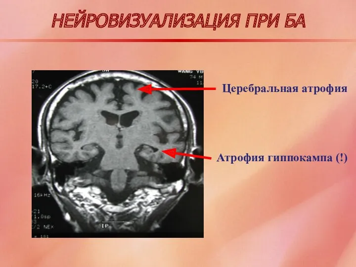 НЕЙРОВИЗУАЛИЗАЦИЯ ПРИ БА Церебральная атрофия Атрофия гиппокампа (!)