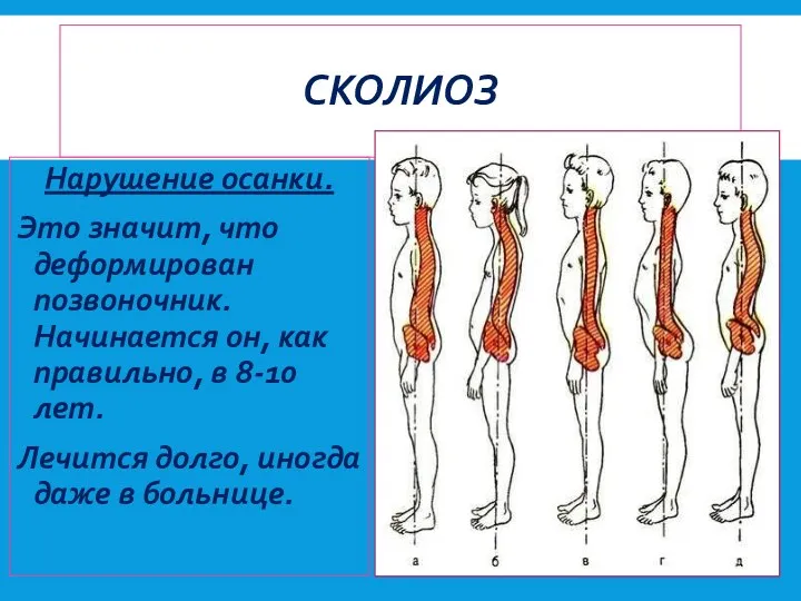 СКОЛИОЗ Нарушение осанки. Это значит, что деформирован позвоночник. Начинается он,