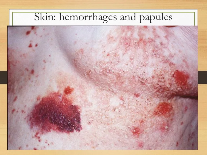 Skin: hemorrhages and papules