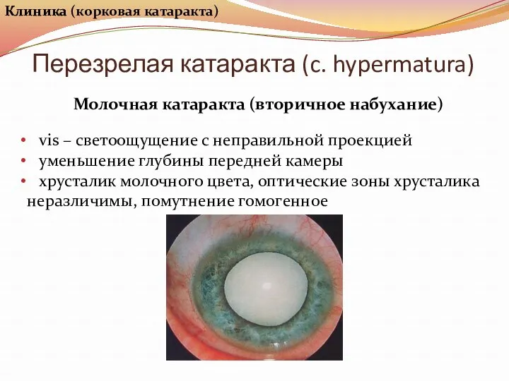 Перезрелая катаракта (c. hypermatura) Клиника Молочная катаракта (вторичное набухание) vis