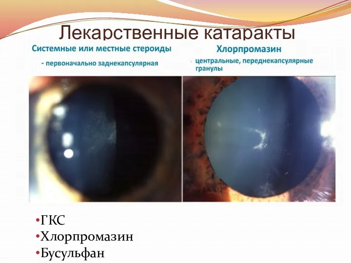 Лекарственные катаракты Стероидная катаракта ГКС Хлорпромазин Бусульфан Амиодарон Препараты Au Аллопуринол