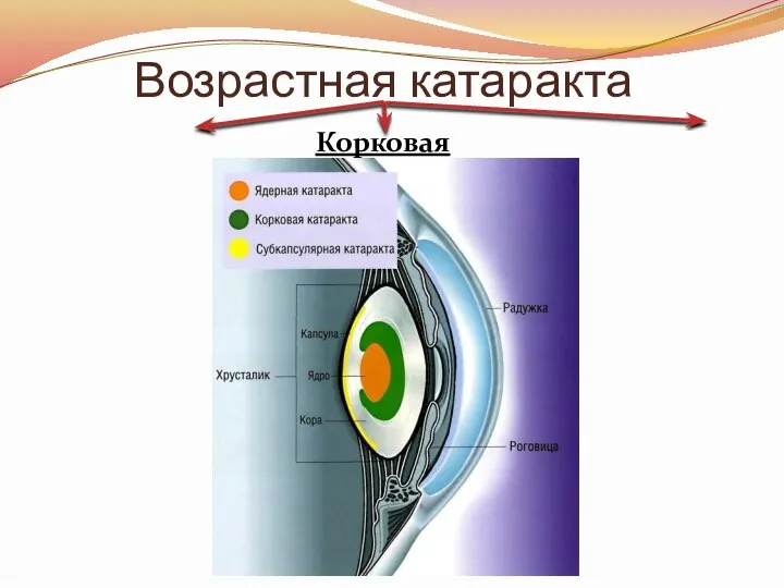 Возрастная катаракта Корковая Ядерная *Субкапсулярная