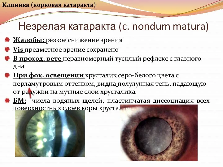 Незрелая катаракта (c. nondum matura) Жалобы: резкое снижение зрения Vis