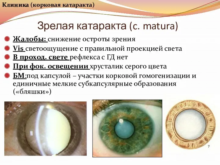 Зрелая катаракта (c. matura) Клиника Жалобы: снижение остроты зрения Vis