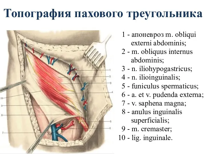 Топография пахового треугольника 1 - апоневроз m. obliqui externi abdominis;