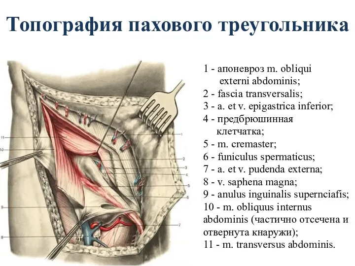 Топография пахового треугольника 1 - апоневроз m. obliqui externi abdominis;