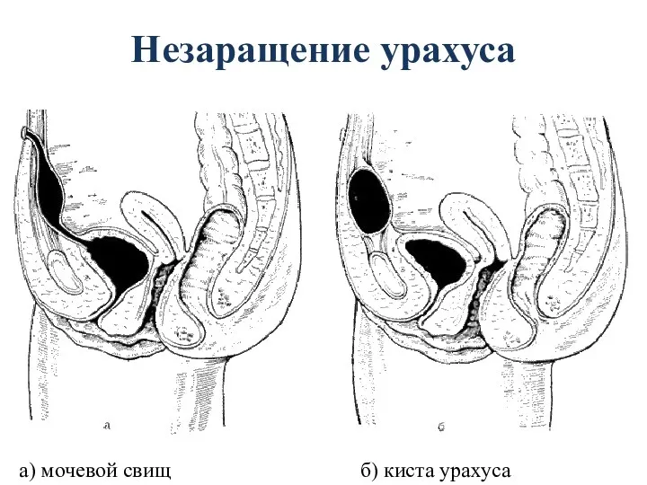 Незаращение урахуса а) мочевой свищ б) киста урахуса