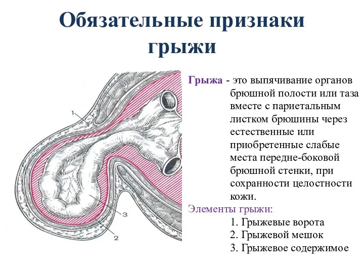 Обязательные признаки грыжи Грыжа - это выпячивание органов брюшной полости