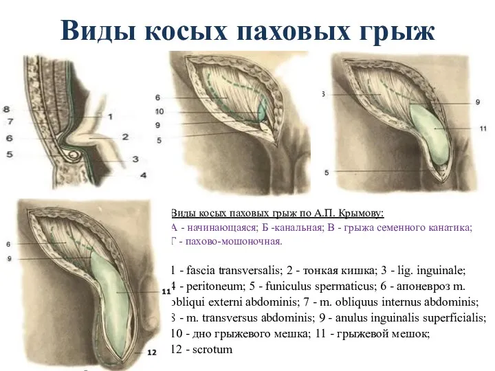 Виды косых паховых грыж Виды косых паховых грыж по А.П.