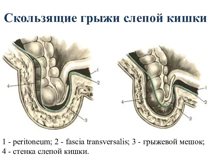 Скользящие грыжи слепой кишки 1 - peritoneum; 2 - fascia