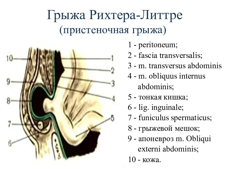 Грыжа Рихтера-Литтре (пристеночная грыжа) 1 - peritoneum; 2 - fascia