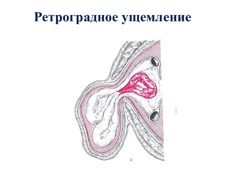 Ретроградное ущемление