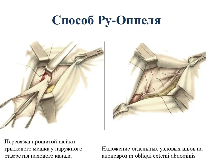 Способ Ру-Оппеля Перевязка прошитой шейки грыжевого мешка у наружного отверстия