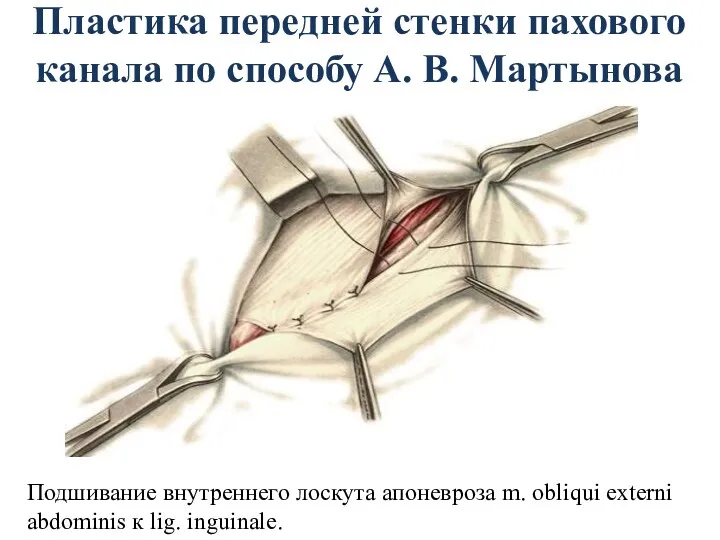 Пластика передней стенки пахового канала по способу А. В. Мартынова