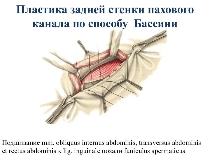 Пластика задней стенки пахового канала по способу Бассини Подшивание mm.