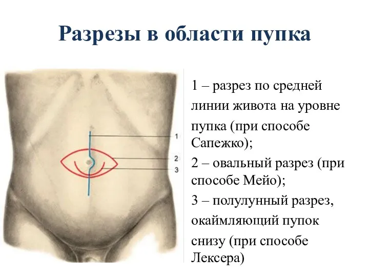 Разрезы в области пупка 1 – разрез по средней линии