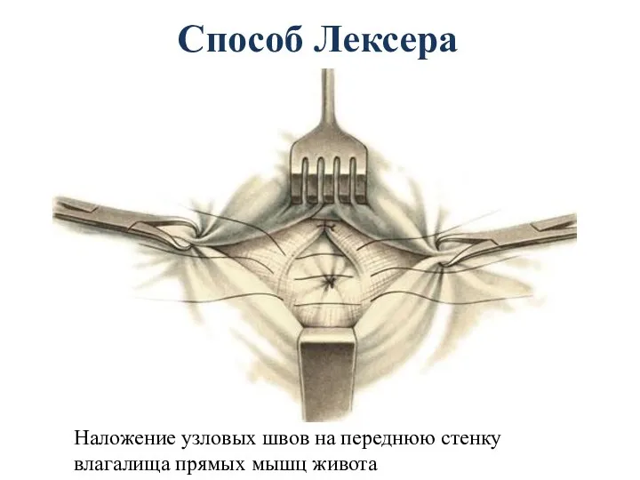 Способ Лексера Наложение узловых швов на переднюю стенку влагалища прямых мышц живота