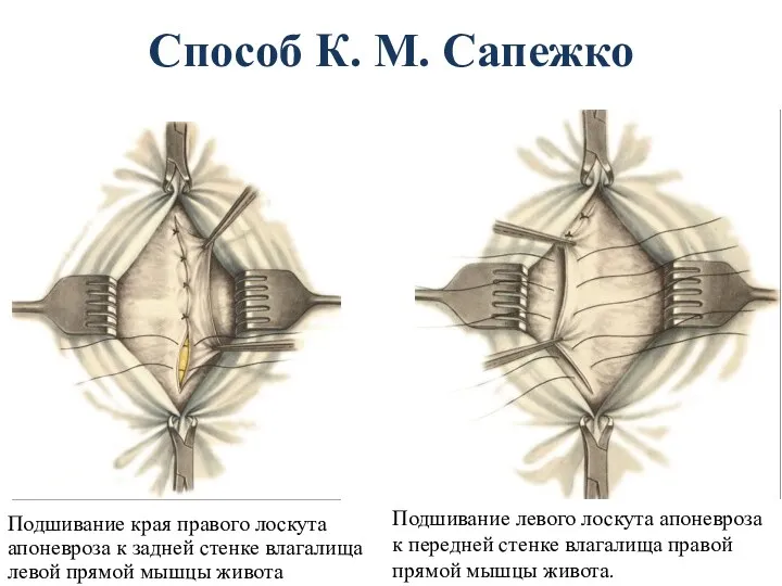 Способ К. М. Сапежко Подшивание края правого лоскута апоневроза к