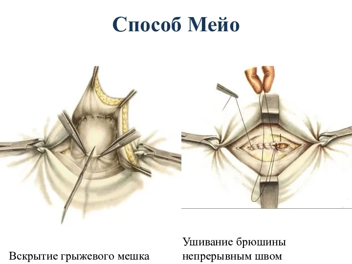 Способ Мейо Вскрытие грыжевого мешка Ушивание брюшины непрерывным швом