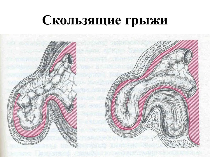 Скользящие грыжи