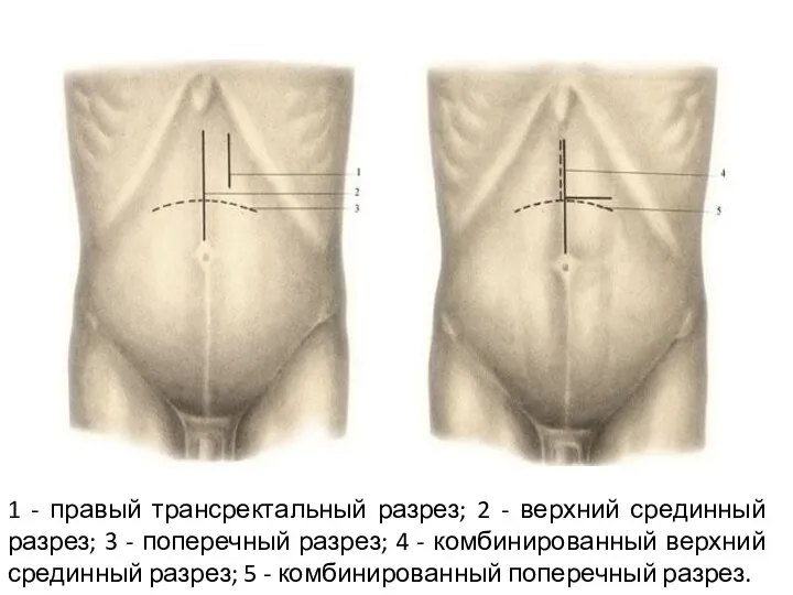 1 - правый трансректальный разрез; 2 - верхний срединный разрез;