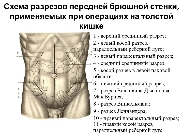 Схема разрезов передней брюшной стенки, применяемых при операциях на толстой