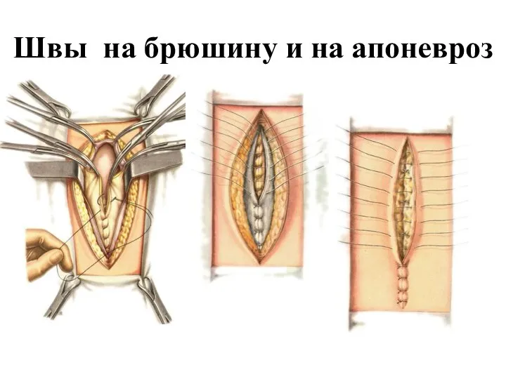 Швы на брюшину и на апоневроз