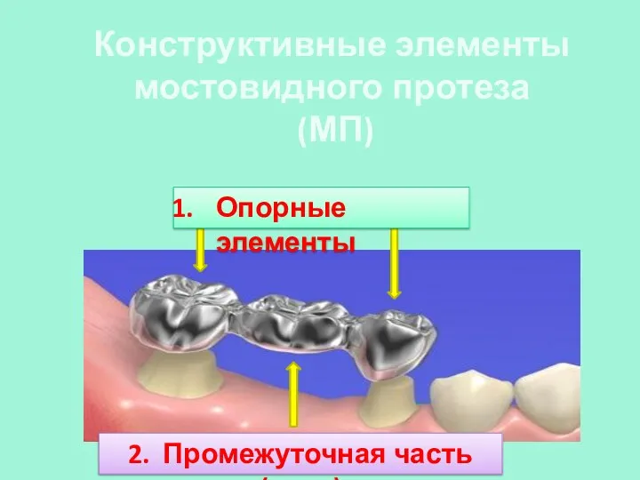Конструктивные элементы мостовидного протеза (МП) Опорные элементы 2. Промежуточная часть (тело)