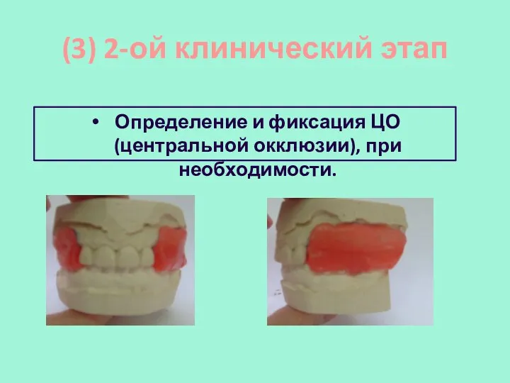 (3) 2-ой клинический этап Определение и фиксация ЦО (центральной окклюзии), при необходимости.