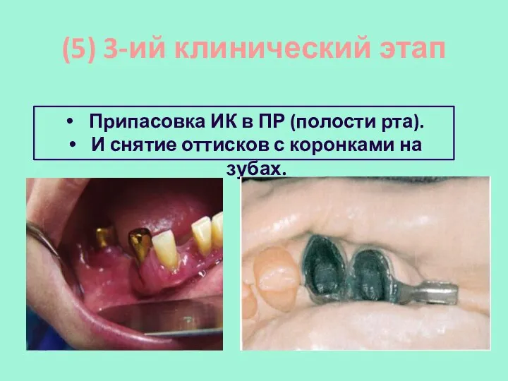 (5) 3-ий клинический этап Припасовка ИК в ПР (полости рта).