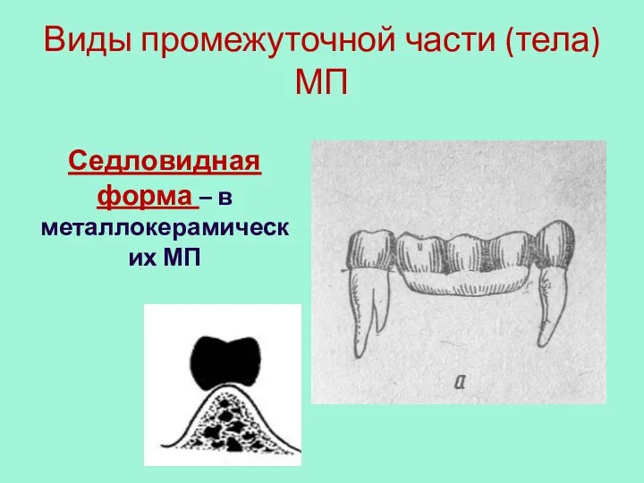 Виды промежуточной части (тела) МП Седловидная форма – в металлокерамических МП