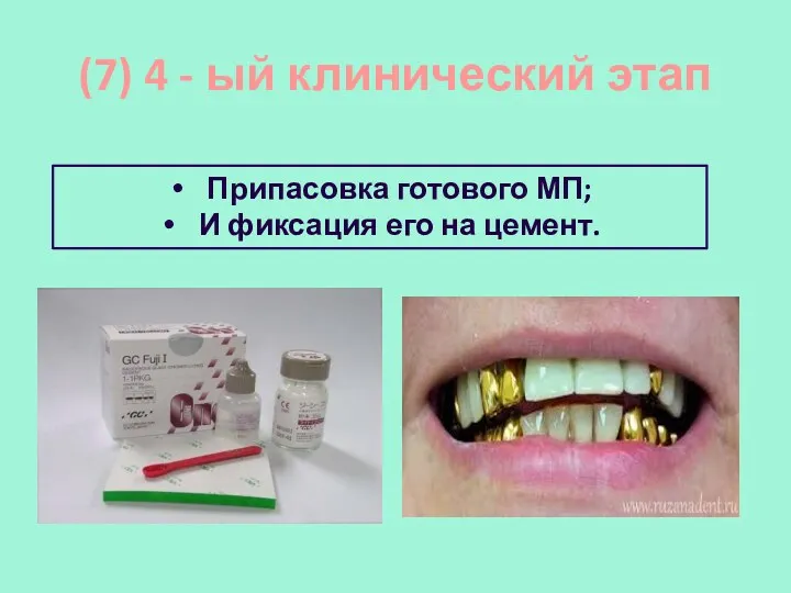 (7) 4 - ый клинический этап Припасовка готового МП; И фиксация его на цемент.