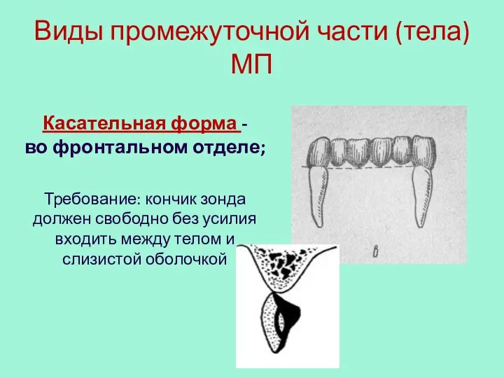 Виды промежуточной части (тела) МП Касательная форма - во фронтальном