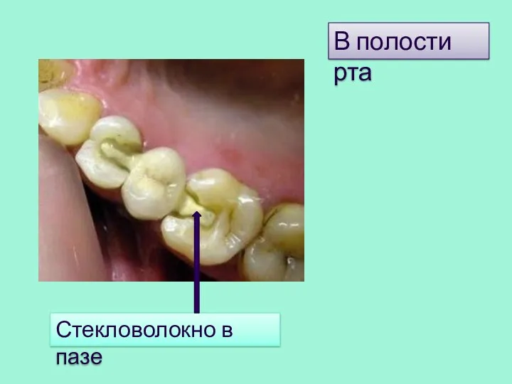 Стекловолокно в пазе В полости рта