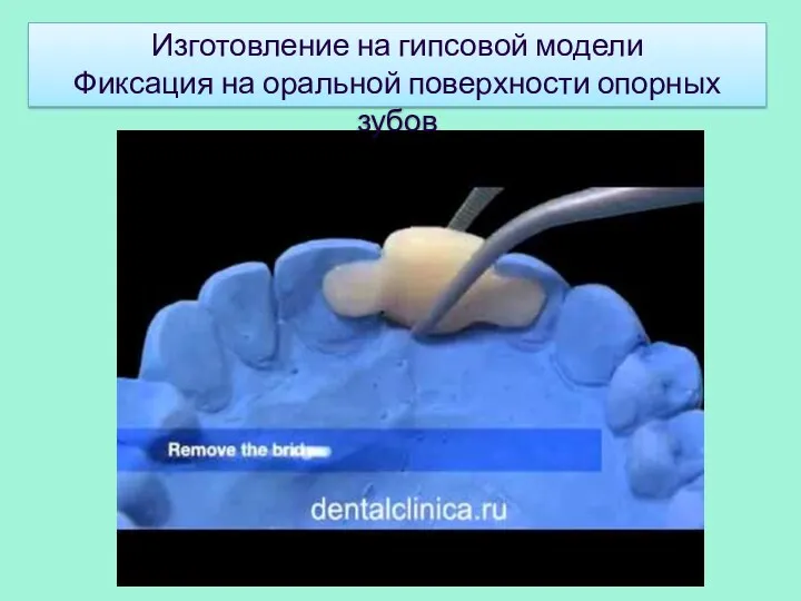 Изготовление на гипсовой модели Фиксация на оральной поверхности опорных зубов