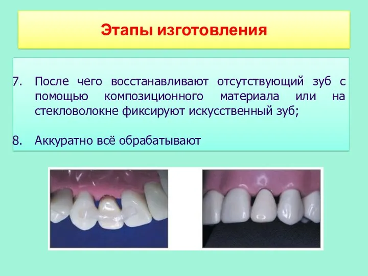 Этапы изготовления После чего восстанавливают отсутствующий зуб с помощью композиционного