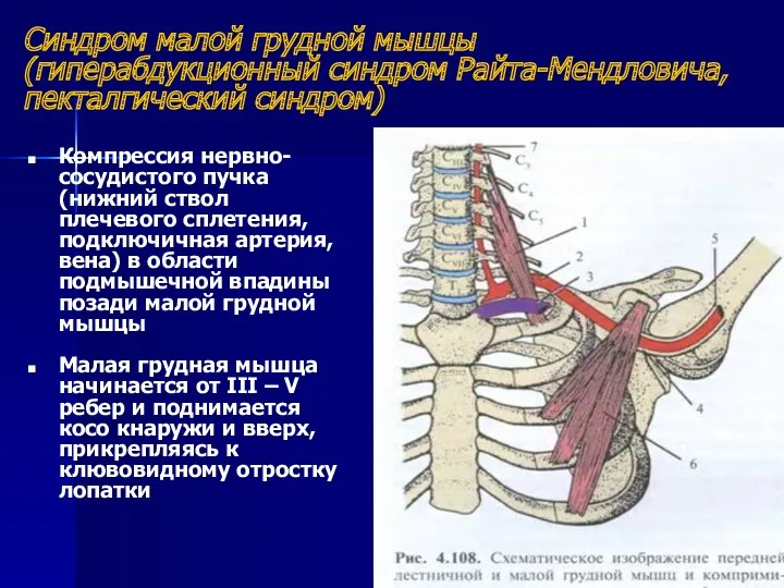 Синдром малой грудной мышцы (гиперабдукционный синдром Райта-Мендловича, пекталгический синдром) Компрессия нервно-сосудистого пучка (нижний