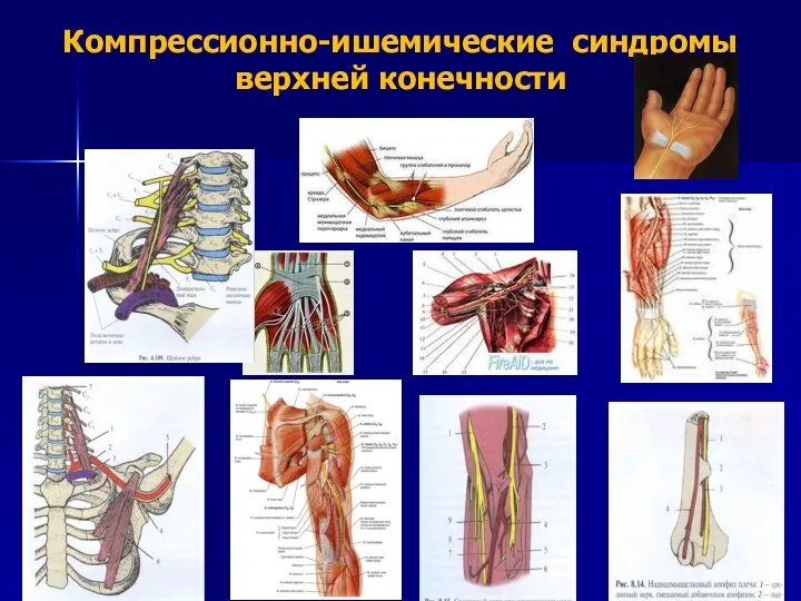 Компрессионно-ишемические синдромы верхней конечности