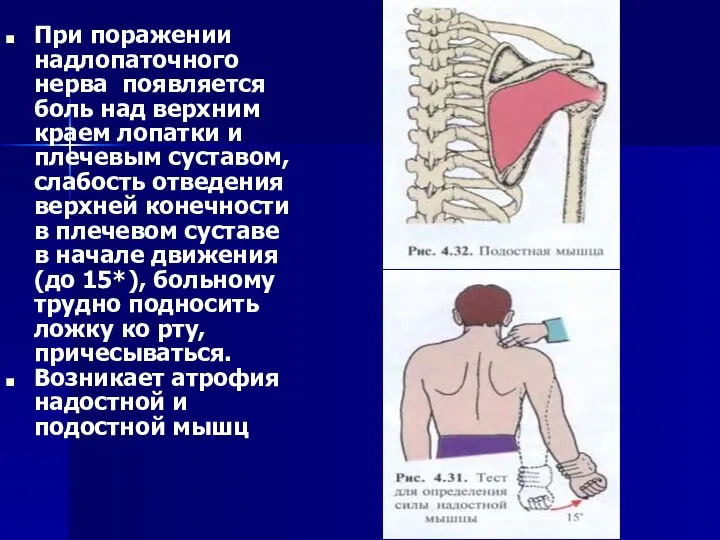 При поражении надлопаточного нерва появляется боль над верхним краем лопатки и плечевым суставом,