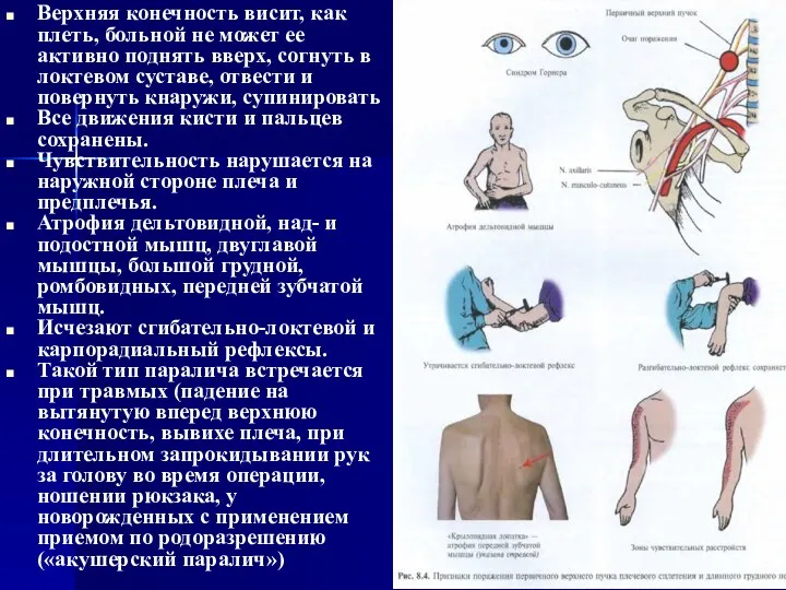 Верхняя конечность висит, как плеть, больной не может ее активно поднять вверх, согнуть