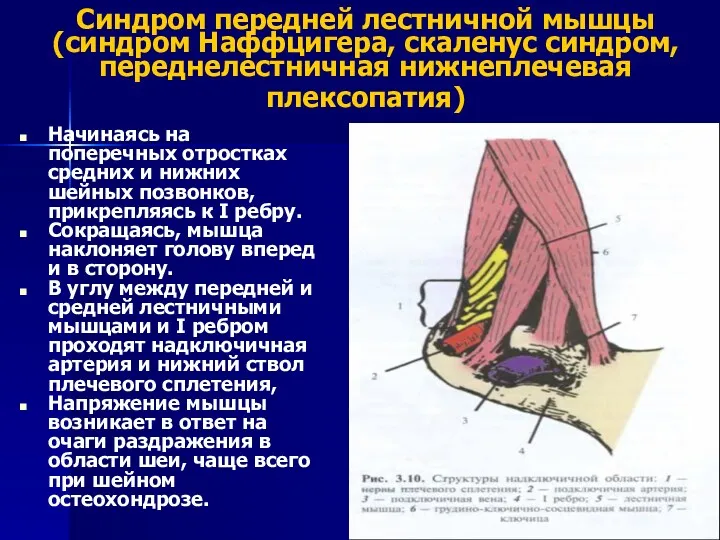 Синдром передней лестничной мышцы (синдром Наффцигера, скаленус синдром, переднелестничная нижнеплечевая