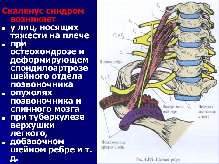 Скаленус синдром возникает у лиц, носящих тяжести на плече при остеохондрозе и деформирующем