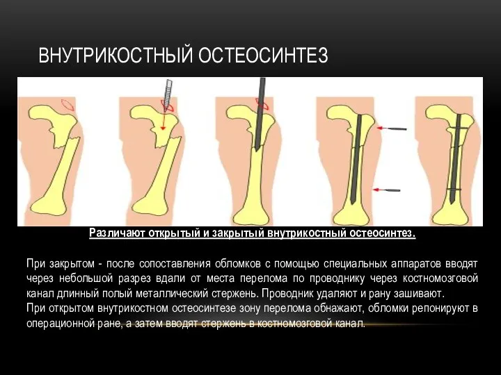 ВНУТРИКОСТНЫЙ ОСТЕОСИНТЕЗ Различают открытый и закрытый внутрикостный остеосинтез. При закрытом