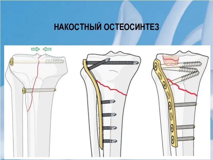 НАКОСТНЫЙ ОСТЕОСИНТЕЗ Костные фрагменты устанавливают в заданном положении, добиваясь точного