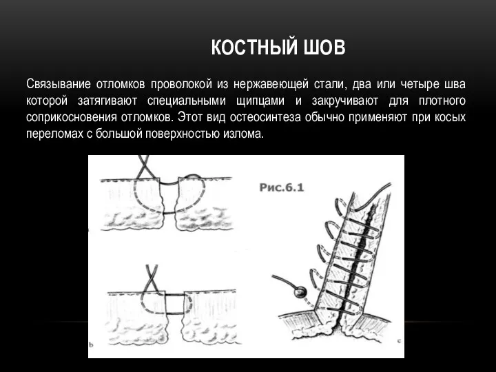 КОСТНЫЙ ШОВ Связывание отломков проволокой из нержавеющей стали, два или