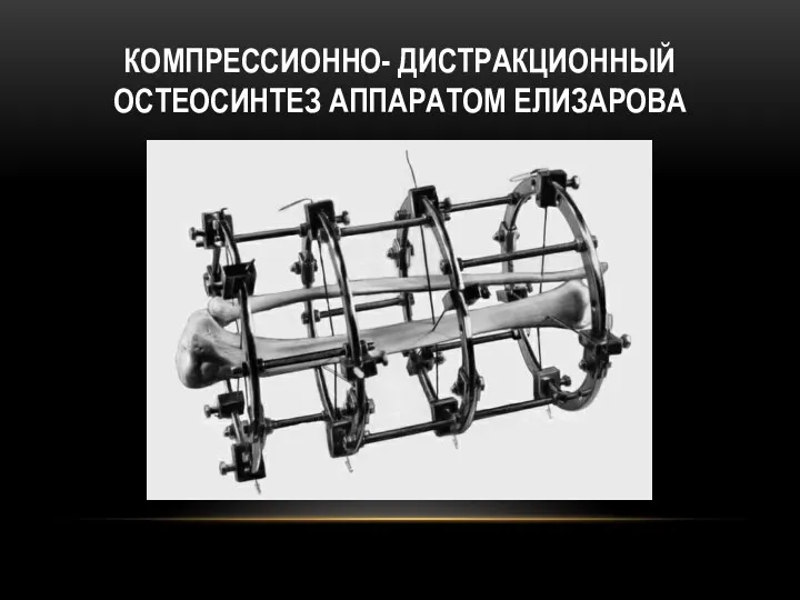 КОМПРЕССИОННО- ДИСТРАКЦИОННЫЙ ОСТЕОСИНТЕЗ АППАРАТОМ ЕЛИЗАРОВА