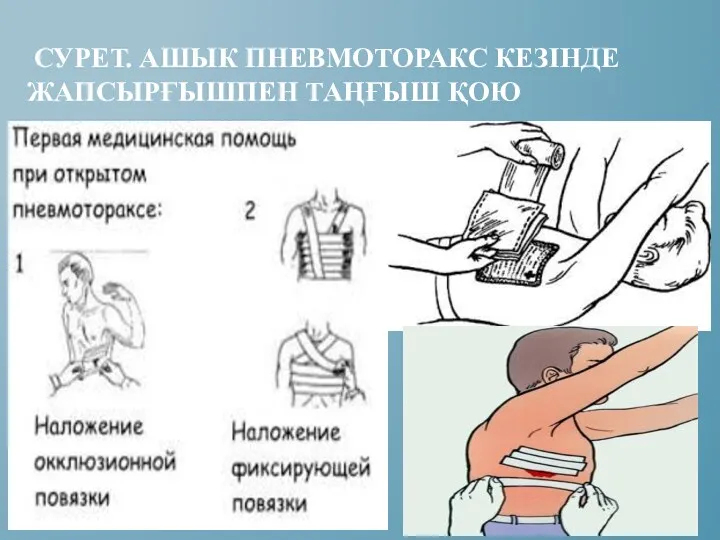 СУРЕТ. АШЫК ПНЕВМОТОРАКС КЕЗІНДЕ ЖАПСЫРҒЫШПЕН ТАҢҒЫШ ҚОЮ